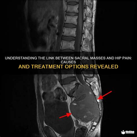 Understanding The Link Between Sacral Masses And Hip Pain: Causes And ...