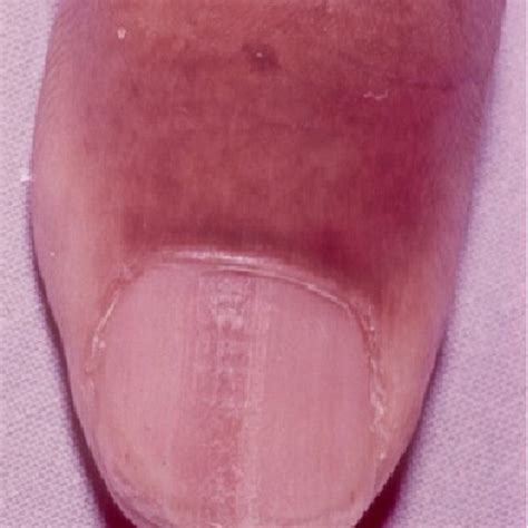 Hutchinson Sign Nail Melanoma - Nail Ftempo