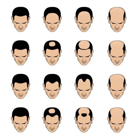 Hair Loss Stages | Osnun