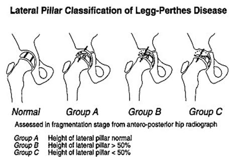 Legg-Calve-Perthes Disease – Core EM