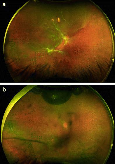 A Combined Traction And Rhegmatogenous Retinal Detachment Affecting