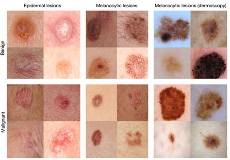 Deep Learning Algorithm Diagnoses Skin Cancer Better Than Human Dermatologists