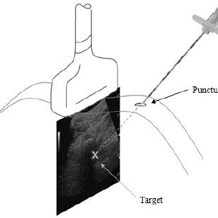 Trajectory Planning In An Ultrasound Guided Needle Insertion Procedure