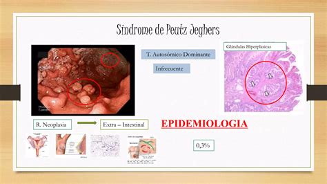 POLIPOS GASTRICOS Y LESIONES SUBEPITELIALES GASTRICAS PPT