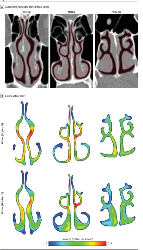 Improving Nasal Airflow With Turbinate Reduction Techniques