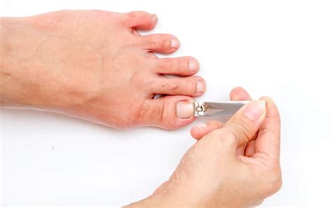 Blister Under Your Toenail? Here's How To Treat It