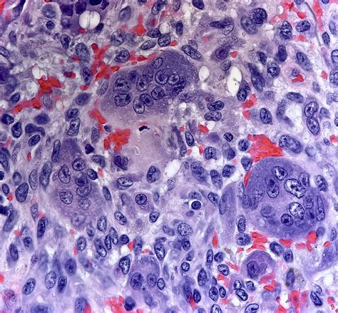 Giant Cell Tumor Of Bone Is Typically Full Of Well Osteoclast Type Giant Cells