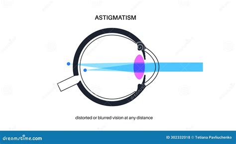 Astigmatisme Oogziekte Stock Illustratie Illustration Of Medisch