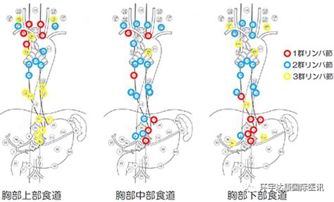 食管癌 食道癌 新药、新技术、新疗法有哪些 全球肿瘤医生网