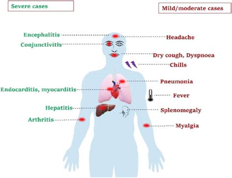 Psittacosis - Symptoms, Causes, Types & Treatment - Santripty