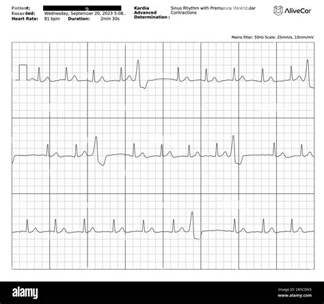 ECG / EKG graph / plot / chart / trace showing some Premature ...