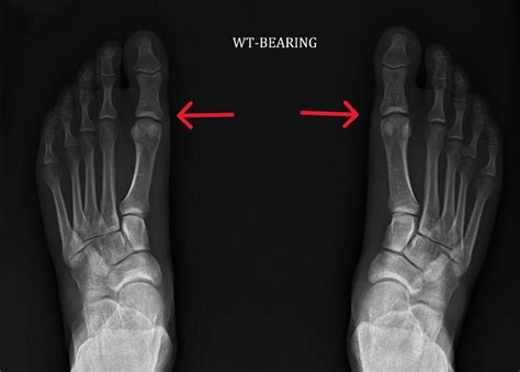 Turf toe: What athletes need to know about this painful injury