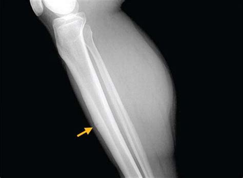 Tibial Stress Fracture Mri