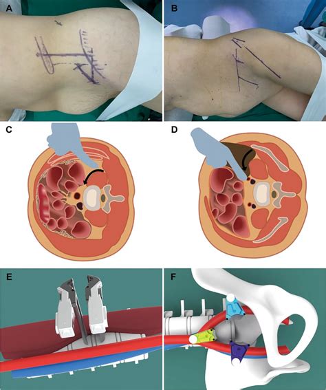 Frontiers Application Of The Oblique Lateral Interbody Fusion