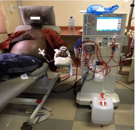 Hemodialysis Patient With An Abundance Of Ascites Reflecting The