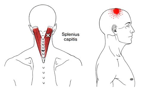 Splenius Capitis | The Trigger Point & Referred Pain Guide