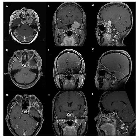 A Case Of 55 Year Old Female With A WHO Grade I Meningioma A C