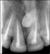 A Case 1 Post Endodontic Intra Oral Peri Apical Radiograph Of Tooth