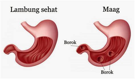 Gejala Penyebab Dan Pengobatan Maag Gastritis Medkes