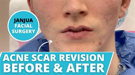 Acne Scar Revision Before And After Dr Tanveer Janjua New Jersey