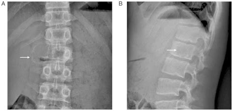 Aneurysmal Bone Cyst Spine