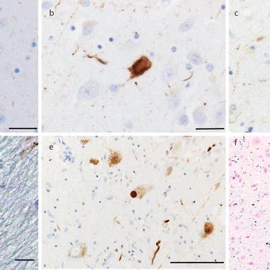 Psp And Comorbid Pathologies A Neurofibrillary Tangle Nft Of Globose