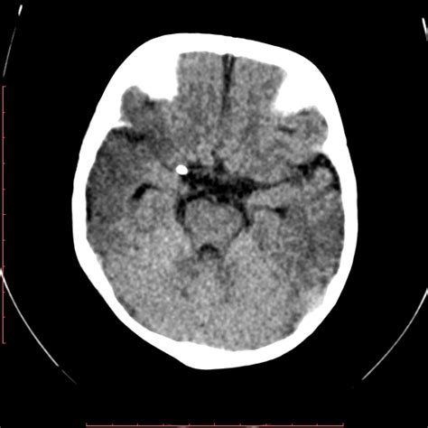 Calcified Middle Cerebral Artery Embolism Image