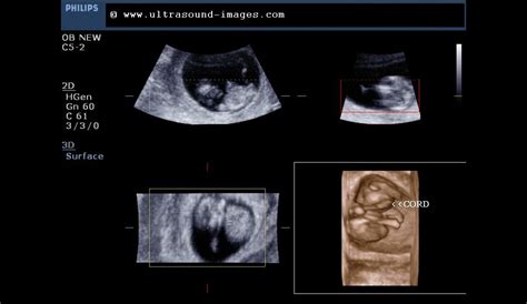 Ultrasound imaging: Fetal 3D-ultrasound images at 10 weeks