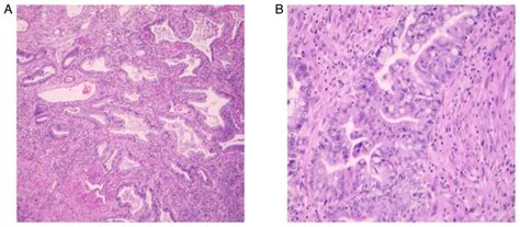 Gastric‑type Endocervical Adenocarcinoma A Report Of Two Cases