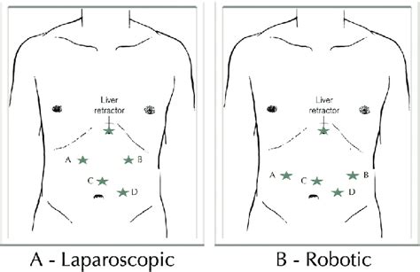 A Laparoscopic And B Robotic Trocar Position For Heller Myotomy And