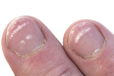 What Are The Little White Spots On Nails Design Talk