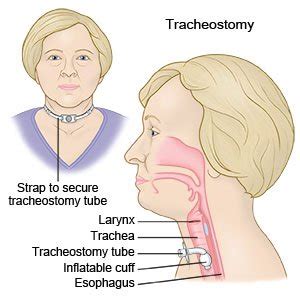 Tracheostomy Tracheostomy Tube Tracheostomy Care Images