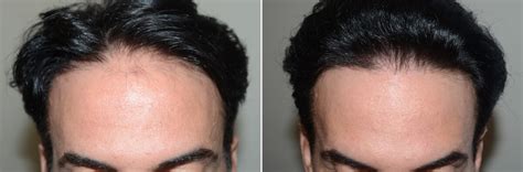 Hair Transplants For Men Photos Miami Fl Patient125275