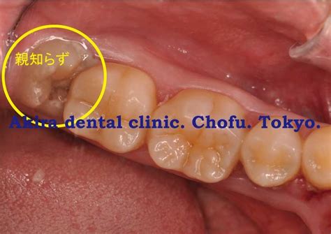 親知らずは抜くべきか？ できれば抜きたくないが。。。 放置するとどうなるの？ 調布市の歯医者ならあきら歯科｜柴崎駅改札正面
