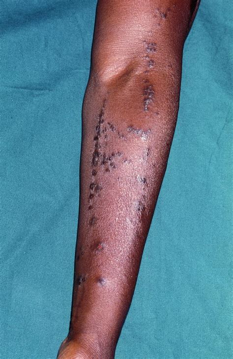 Lichen Planus Skin Disease 1 Photograph By Dr M A Ansary Science