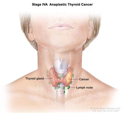 Thyroid Cancer Treatment Adult Pdq®patient Version National