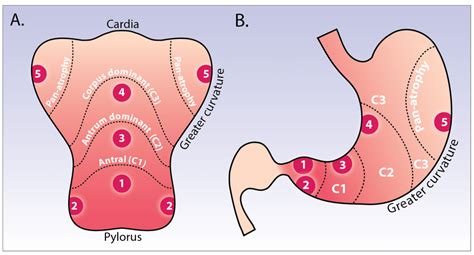 Mistakes In The Management Of Gastric Polyps And How To Off