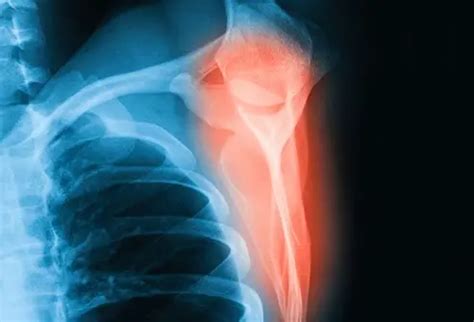 6 Symptoms of a Broken Shoulder Blade: Causes, Treatment, Prevention ...