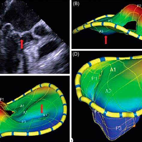 Primary Mitral Regurgitation Due To Pl Prolapse Transoesophageal