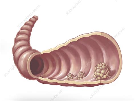 Intestinal Polyps, illustration - Stock Image - C039/3682 - Science ...