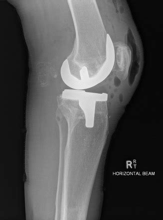 Baker Cyst Radiology Reference Article Radiopaedia Org