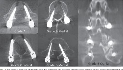 Figure 2 From Accuracy Of Percutaneous Lumbosacral Pedicle Screw