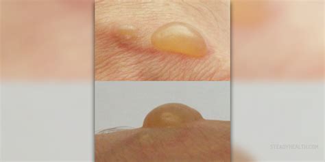 Sun poisoning blisters | Skin & Hair problems articles | Body & Health ...