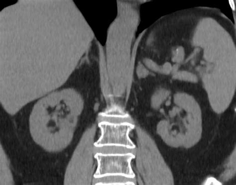 Bilateral Adrenal Adenomas Adrenal Case Studies Ctisus Ct Scanning