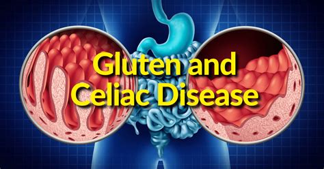 Thyroid Gland Thyroid Disease Gluten Sensitivity And Celiac Disease