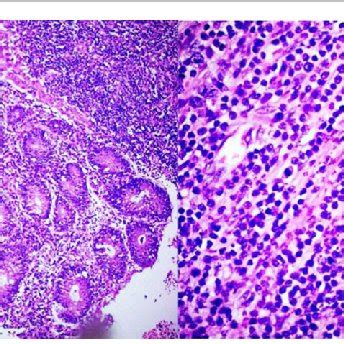 PDF Monomorphic Epitheliotropic Intestinal T Cell Lymphomas A Case