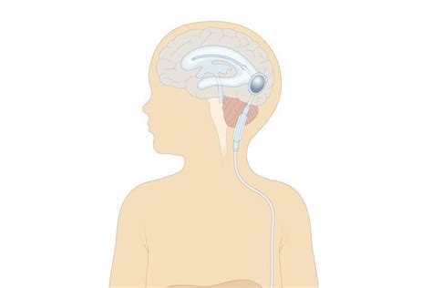 Shunt Placement for Hydrocephalus