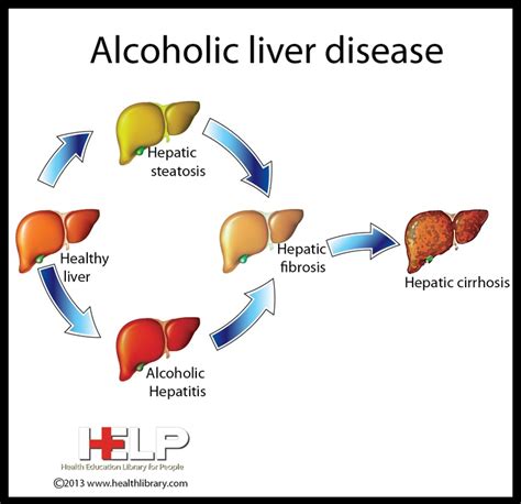 Diseases: Alcoholic Liver Disease