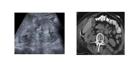 RENAL PARENCHYMAL DISEASE IMAGING.pptx