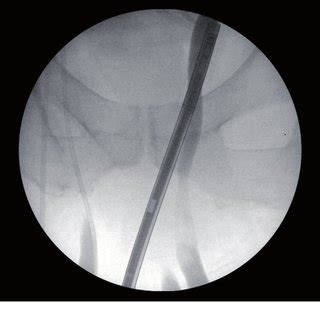 Lacunar Ligament Anatomy